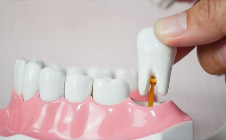 Extractions dentaires : 
pas que pour les dents de sagesse