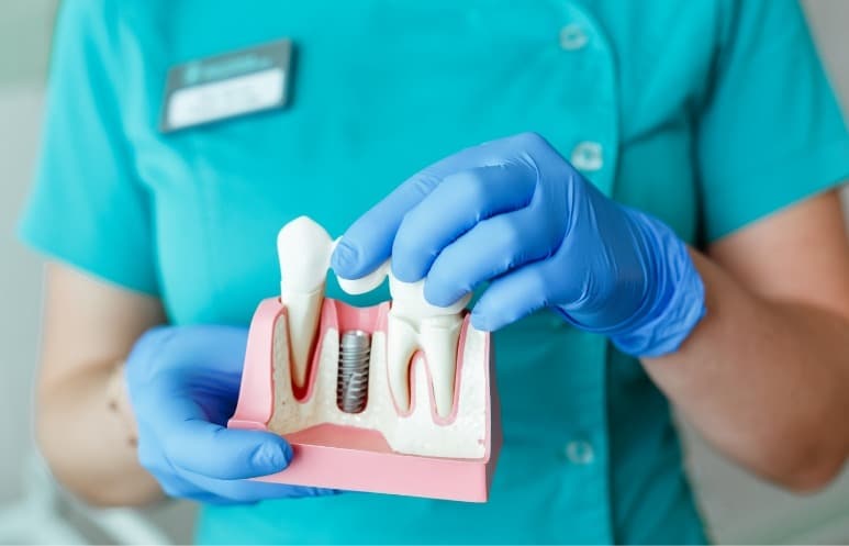 Les implants dentaires, une option de remplacement polyvalente 